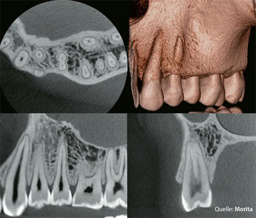 3D-DVT Befundbilder · Quelle: Morita