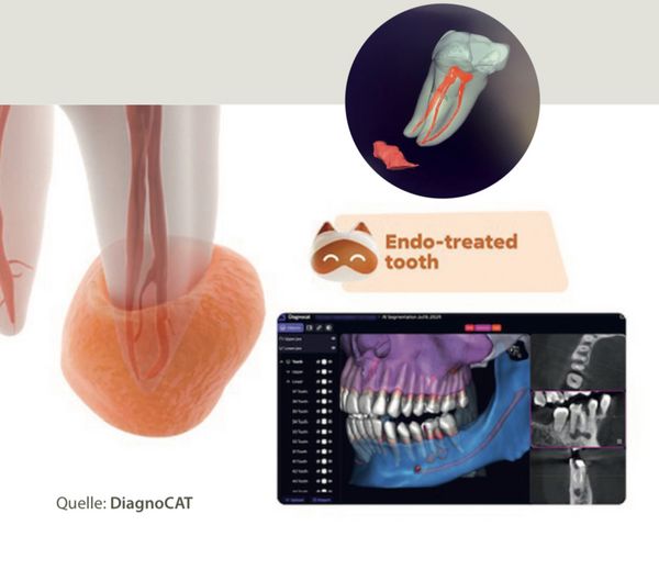 Endodontie-Diagnostik: digitale 3D-Darstellung eines Zahns
